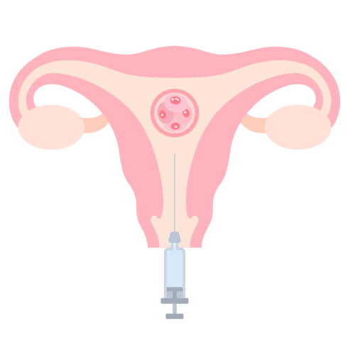 Blastocyst transfer